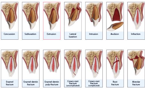 NJ Root Canal